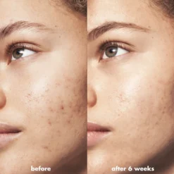 Blemish Breakthrough Acne Calming Water Cream