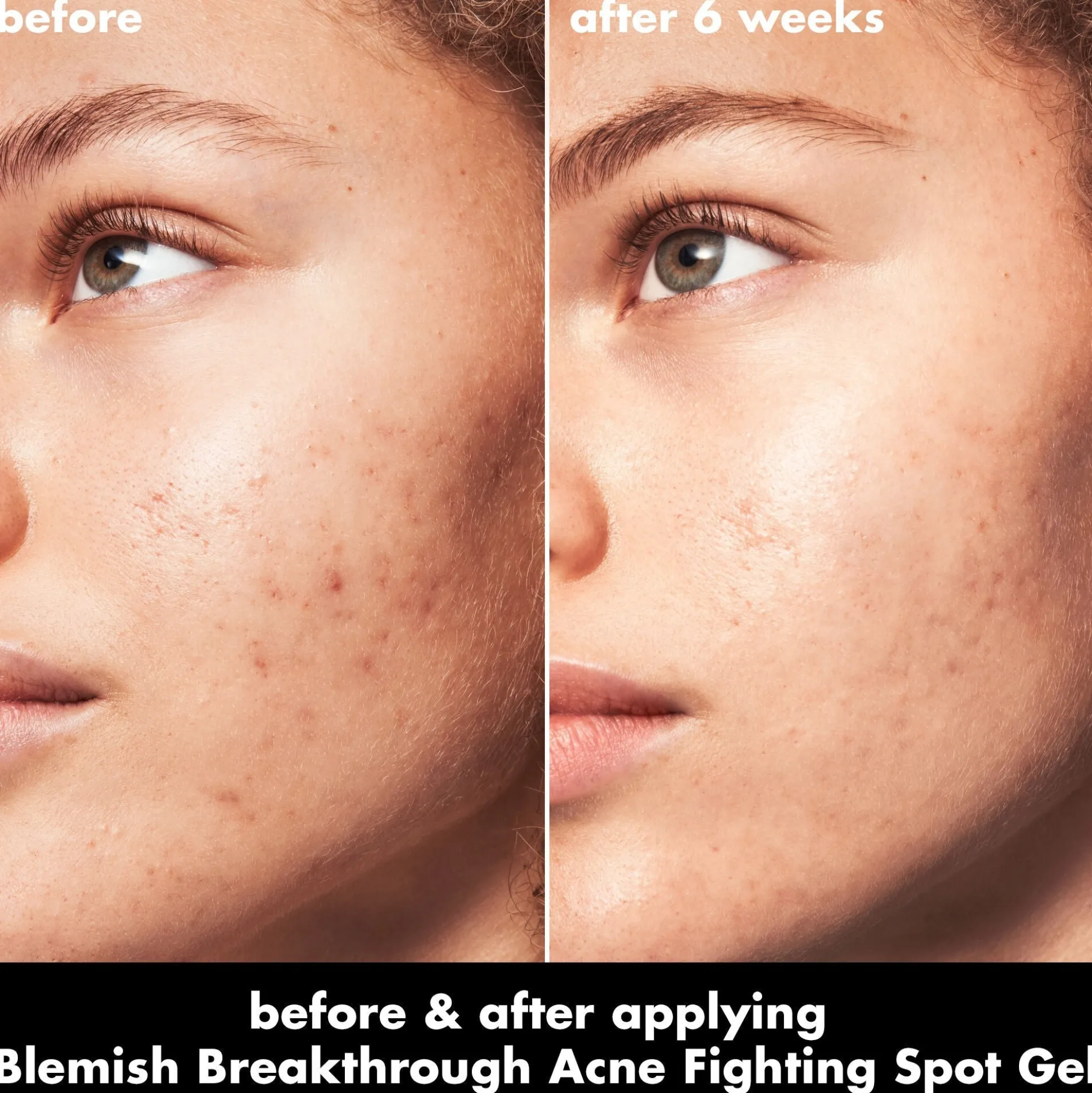 Blemish Breakthrough Acne Fighting Spot Gel
