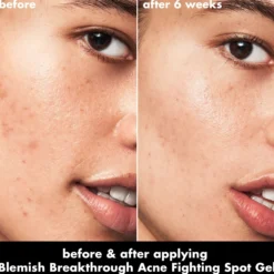 Blemish Breakthrough Acne Fighting Spot Gel