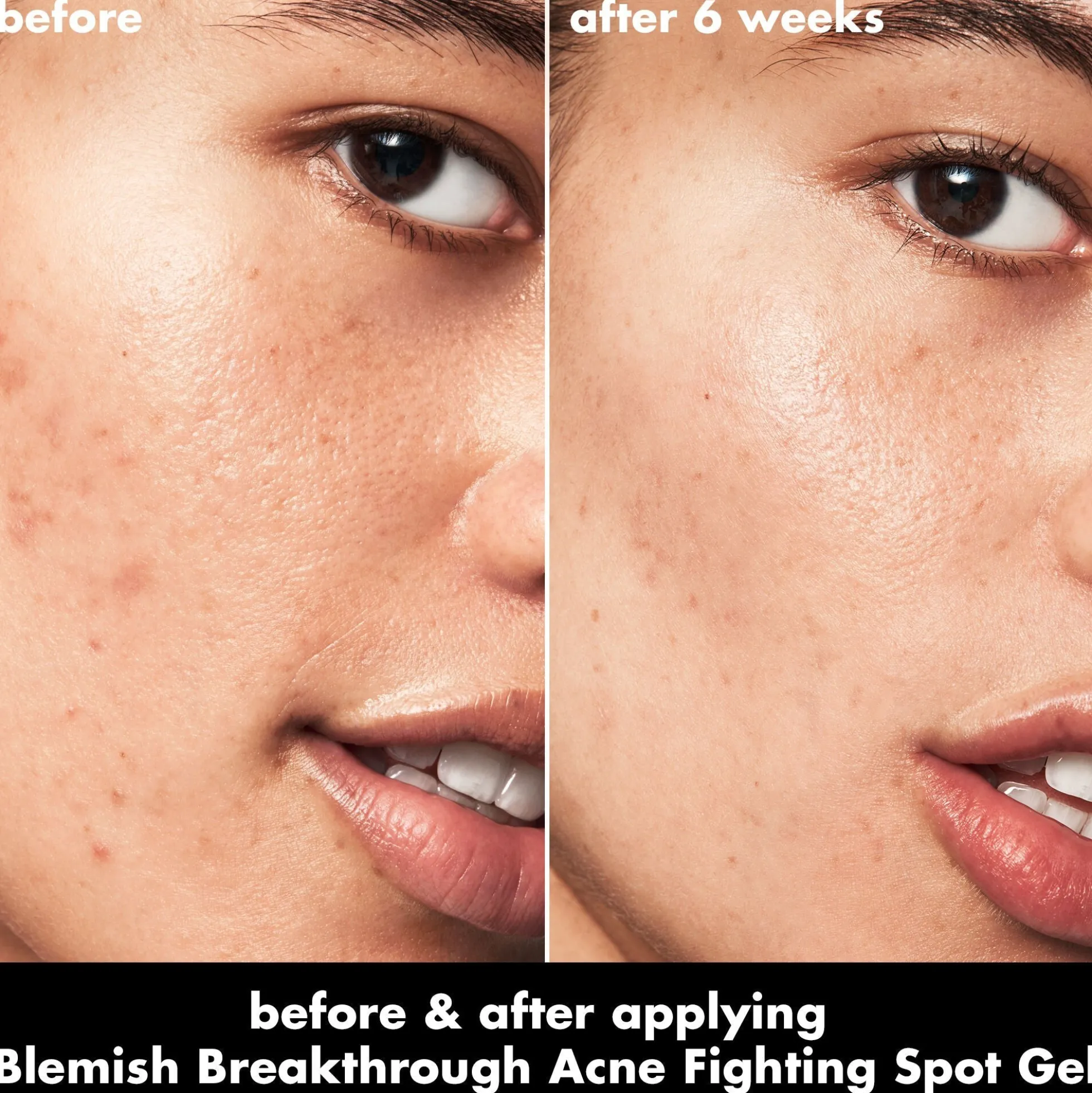 Blemish Breakthrough Acne Fighting Spot Gel
