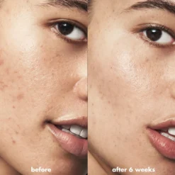 Blemish Breakthrough Triple-acid Resurfacing Serum