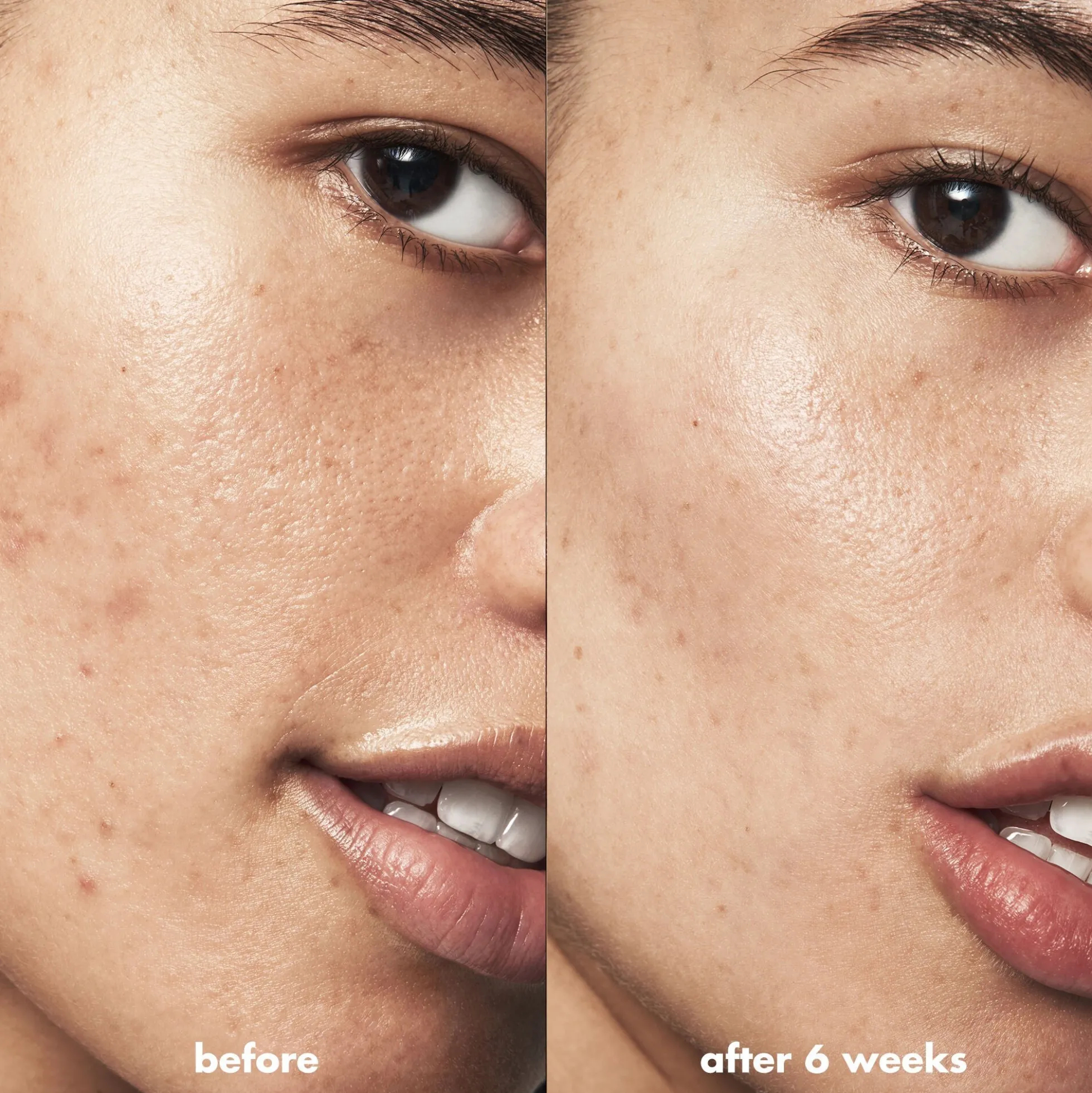 Blemish Breakthrough Triple-acid Resurfacing Serum